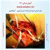 آمبولی شریانی 19