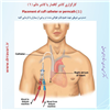 کارگزاری کاتتر دائم 1