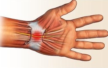 سندرم تونل کارپ ( مچ دست)