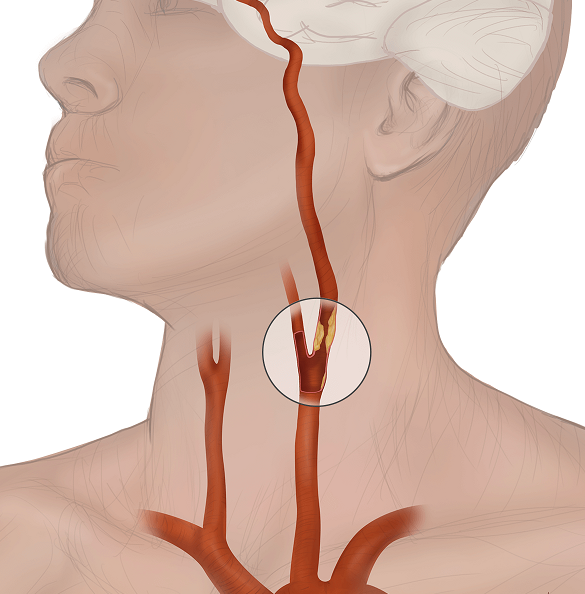 Операция на артерии шеи. Атеросклероз сонных артерий. Бляшко на сонном артерии. Бляшка сонной ар терииэ.